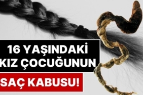 Nadir Görülen 'Rapunzel Sendromu' Ameliyat Gerektirecek Kadar Büyük Bir Saç Yumağına Neden Olabiliyor