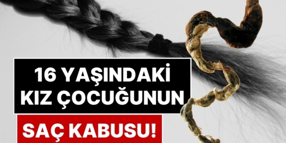 Nadir Görülen 'Rapunzel Sendromu' Ameliyat Gerektirecek Kadar Büyük Bir Saç Yumağına Neden Olabiliyor