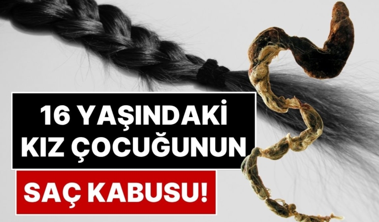 Nadir Görülen 'Rapunzel Sendromu' Ameliyat Gerektirecek Kadar Büyük Bir Saç Yumağına Neden Olabiliyor